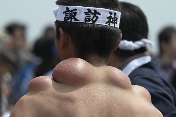 神輿瘤