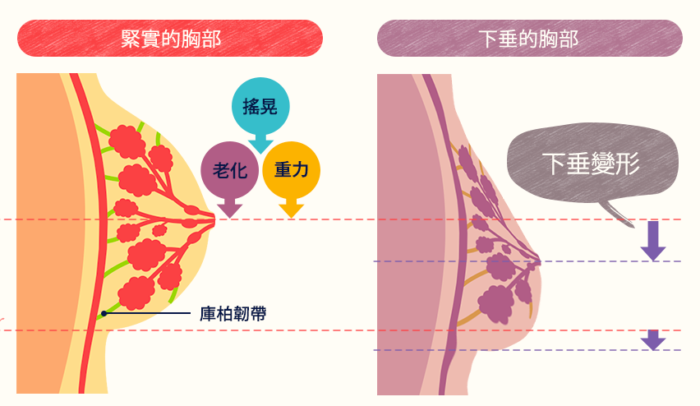 Viage晚安內衣_胸型問題